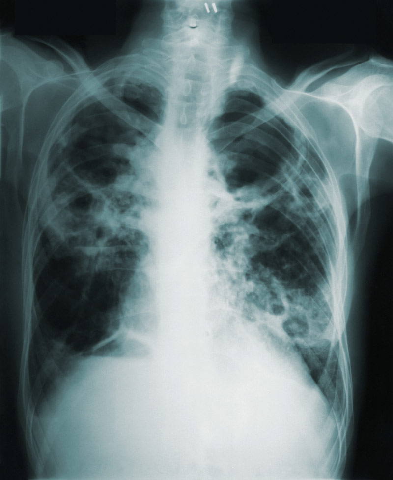 Radiografía de tórax para diagnóstico de tuberculosis